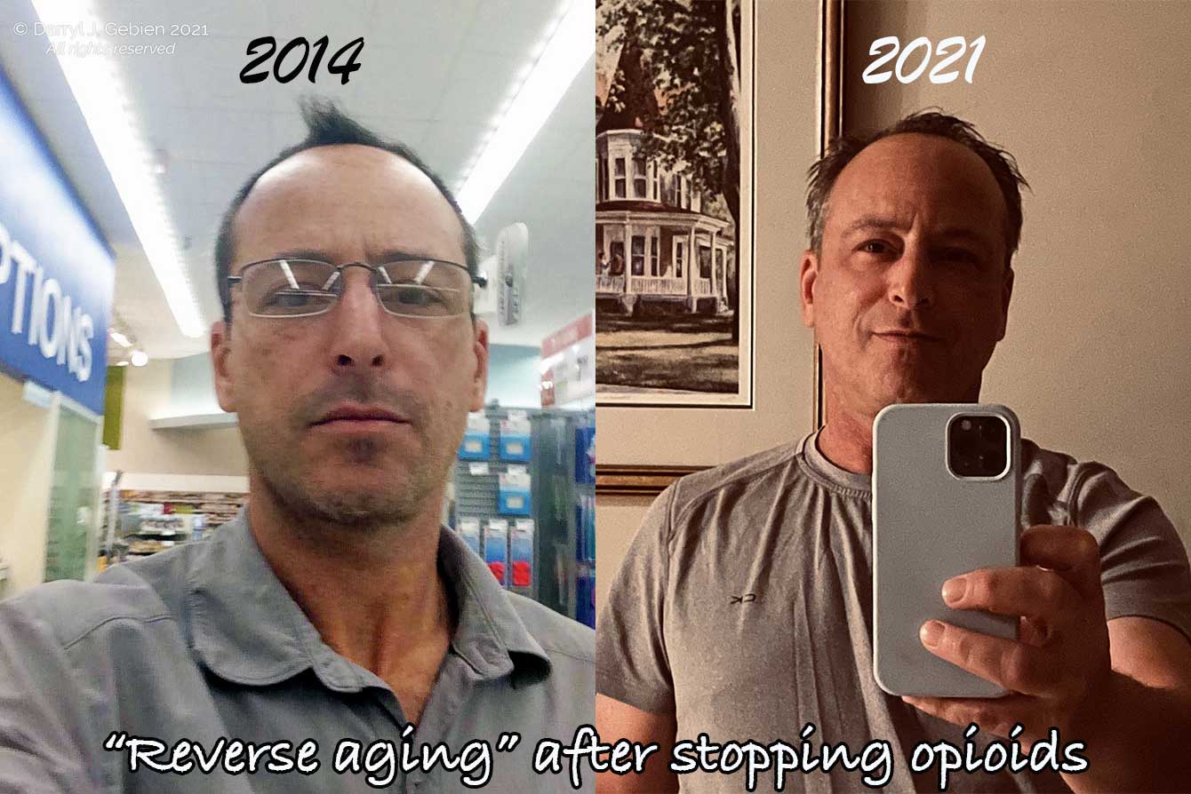 Self-photographs of Darryl Gebien both before and after quitting opioids. Dr. Gebien survived fentanyl and even retained his medical license. Brutal honesty helped that along. After finally (and reluctantly) stopping his fentanyl use, a major transformation took place where his appearance improved.
